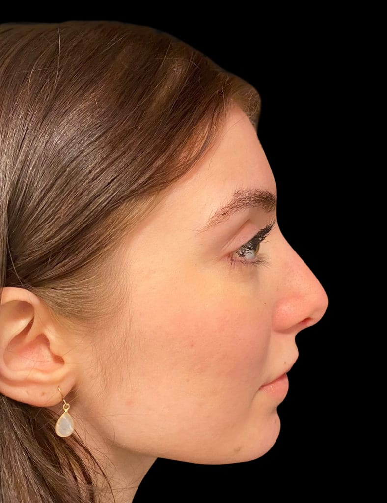 Rhinoplasty Before & After Gallery - Patient 58232347 - Image 2