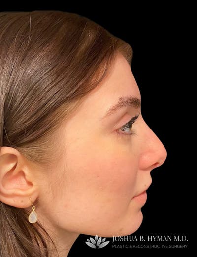Rhinoplasty Before & After Gallery - Patient 58232347 - Image 2