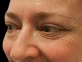Blepharoplasty Before & After Gallery - Patient 58232301 - Image 1