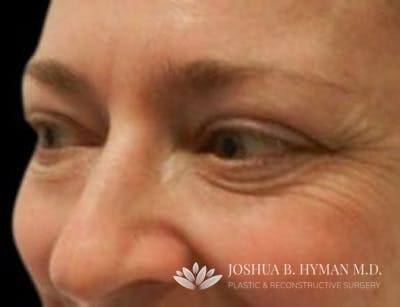 Blepharoplasty Before & After Gallery - Patient 58232301 - Image 1