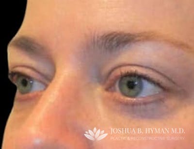 Blepharoplasty Before & After Gallery - Patient 58232301 - Image 2