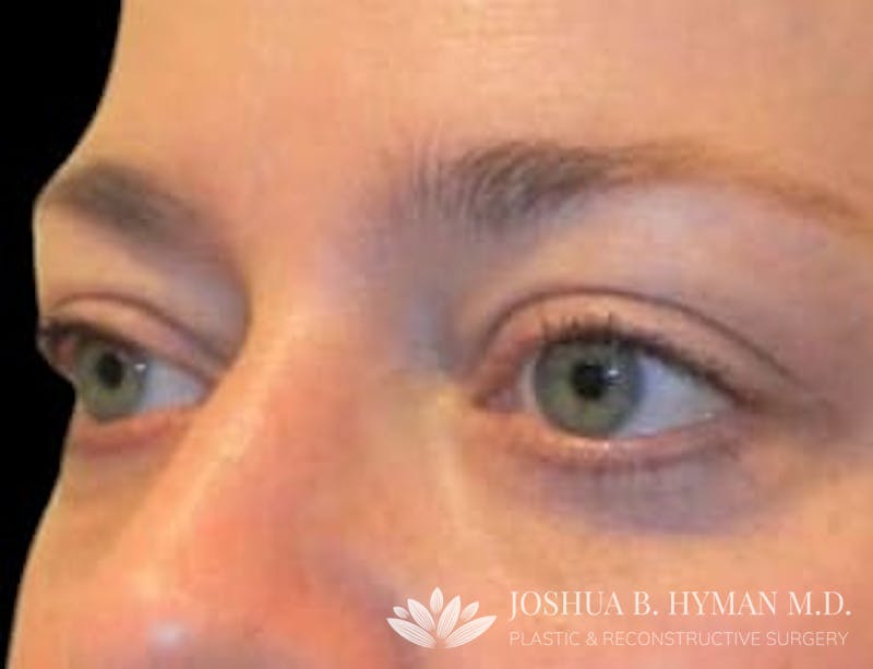 Blepharoplasty Before & After Gallery - Patient 58232301 - Image 2