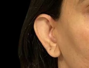 Otoplasty Before & After Gallery - Patient 58232317 - Image 1