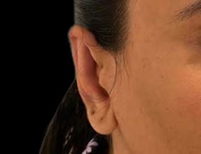 Otoplasty Before & After Gallery - Patient 58232317 - Image 2