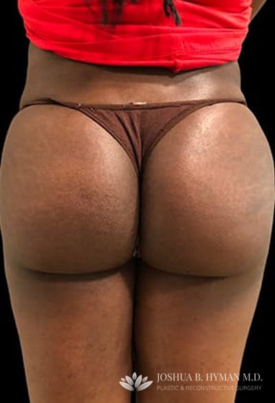 Brazilian Butt Lift Before & After Gallery - Patient 77368627 - Image 2