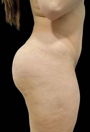 Brazilian Butt Lift Before & After Gallery - Patient 77368629 - Image 2