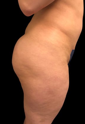 Brazilian Butt Lift Before & After Gallery - Patient 77368629 - Image 1