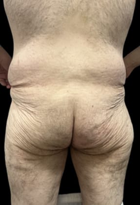 Male Liposuction Before & After Gallery - Patient 290370 - Image 1