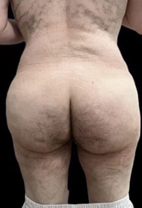 Male Liposuction Before & After Gallery - Patient 290370 - Image 2