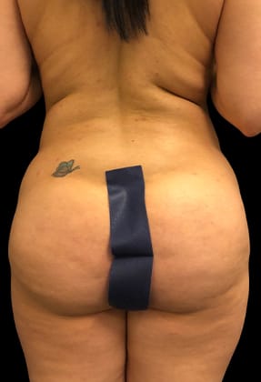 Brazilian Butt Lift Before & After Gallery - Patient 77368641 - Image 1