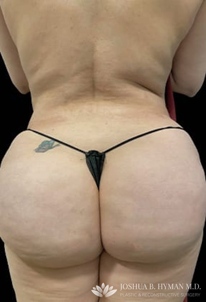 Brazilian Butt Lift Before & After Gallery - Patient 77368641 - Image 2