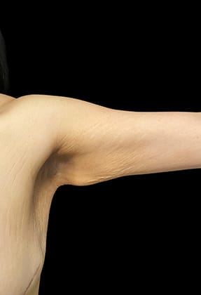 Brachioplasty Before & After Gallery - Patient 77368657 - Image 1