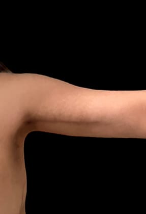 Brachioplasty Before & After Gallery - Patient 77368657 - Image 2