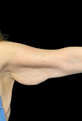 Brachioplasty Before & After Gallery - Patient 77368658 - Image 1