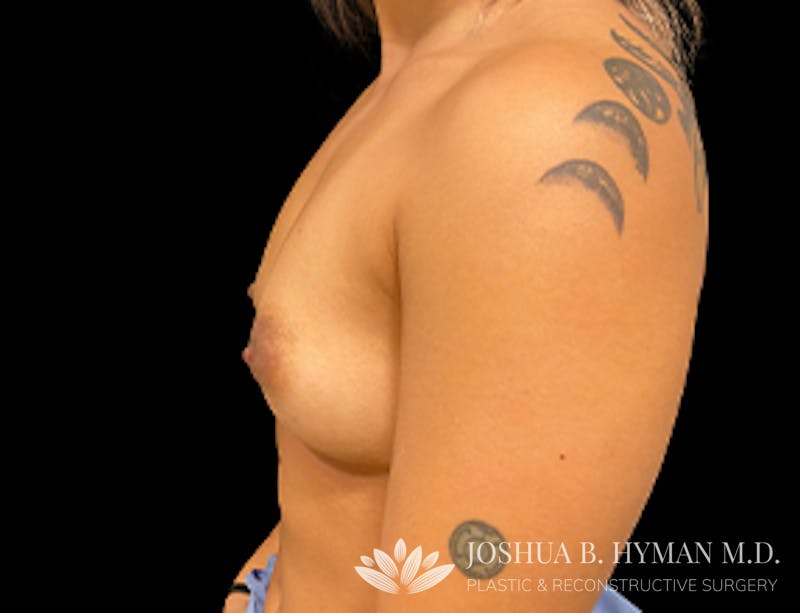 Breast Augmentation Before & After Gallery - Patient 77368670 - Image 3
