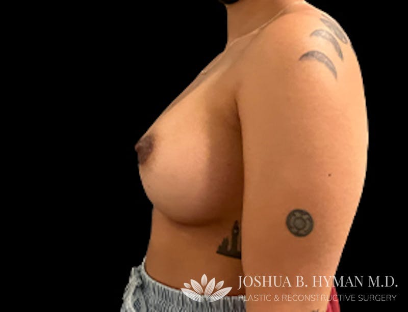 Breast Augmentation Before & After Gallery - Patient 77368670 - Image 4