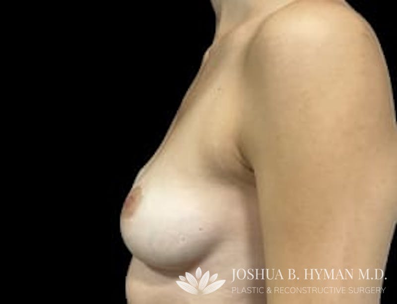 Breast Augmentation Before & After Gallery - Patient 77368673 - Image 3