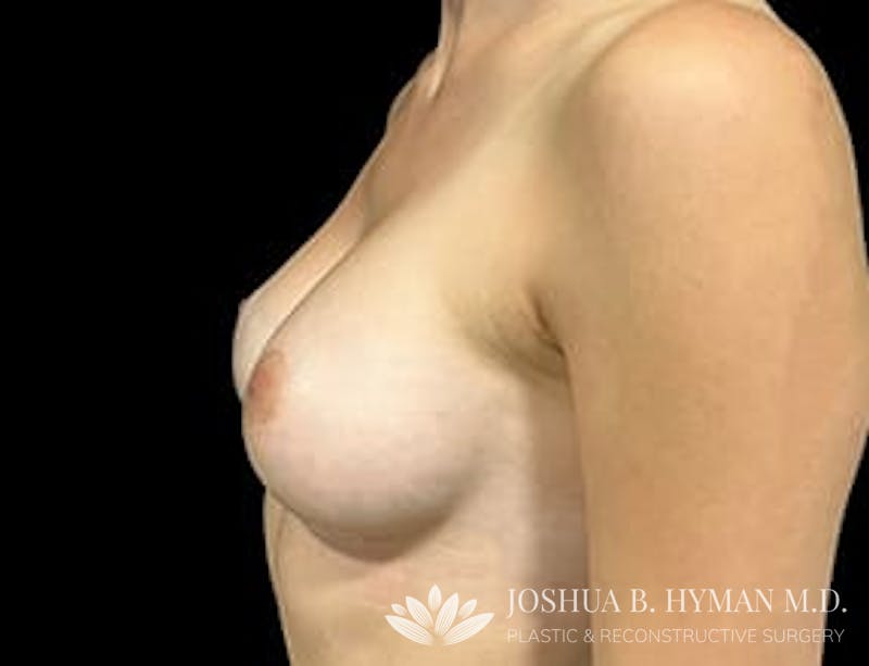 Breast Augmentation Before & After Gallery - Patient 77368673 - Image 4
