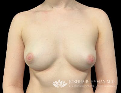 Breast Augmentation Before & After Gallery - Patient 77368674 - Image 1