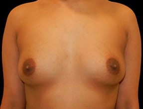 Breast Augmentation Before & After Gallery - Patient 77368680 - Image 1