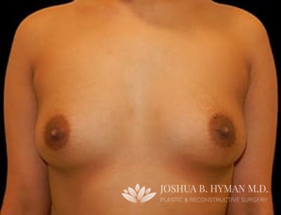 Breast Augmentation Before & After Gallery - Patient 77368680 - Image 1