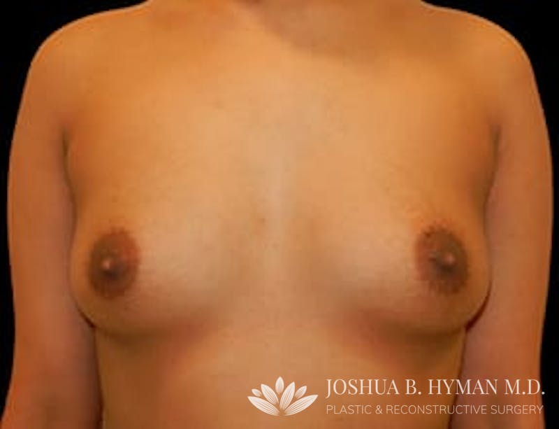Breast Augmentation Before & After Gallery - Patient 77368680 - Image 1
