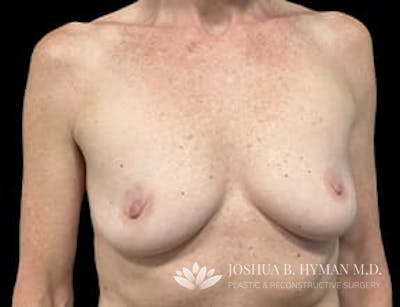 Breast Augmentation Before & After Gallery - Patient 77368700 - Image 1