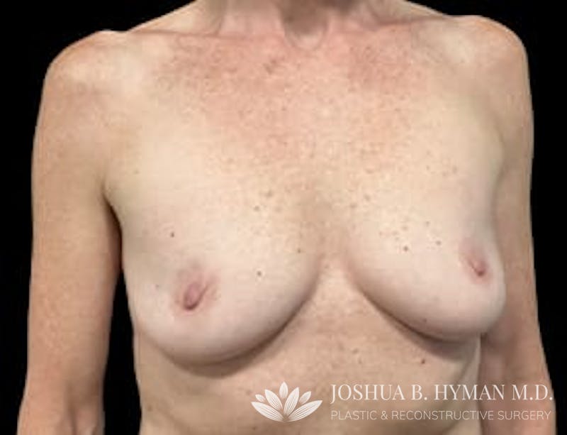 Breast Augmentation Before & After Gallery - Patient 77368700 - Image 1