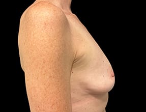 Breast Augmentation Before & After Gallery - Patient 77368700 - Image 3