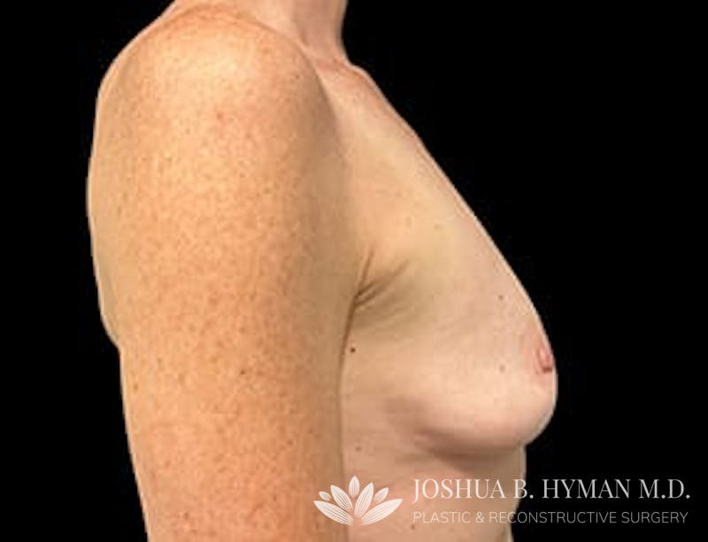 Breast Augmentation Before & After Gallery - Patient 77368700 - Image 3