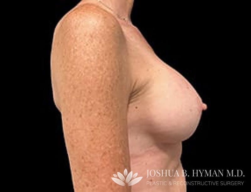 Breast Augmentation Before & After Gallery - Patient 77368700 - Image 4
