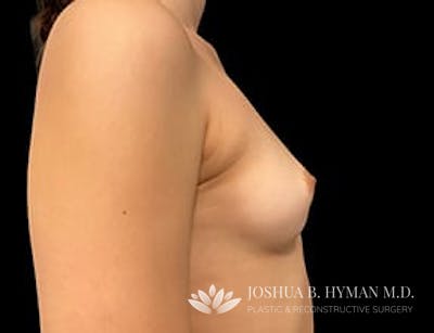 Breast Augmentation Before & After Gallery - Patient 77369232 - Image 1