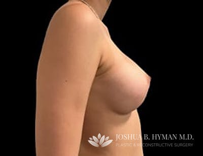 Breast Augmentation Before & After Gallery - Patient 77369232 - Image 2