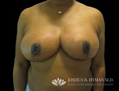 Breast Reduction Before & After Gallery - Patient 77369242 - Image 2