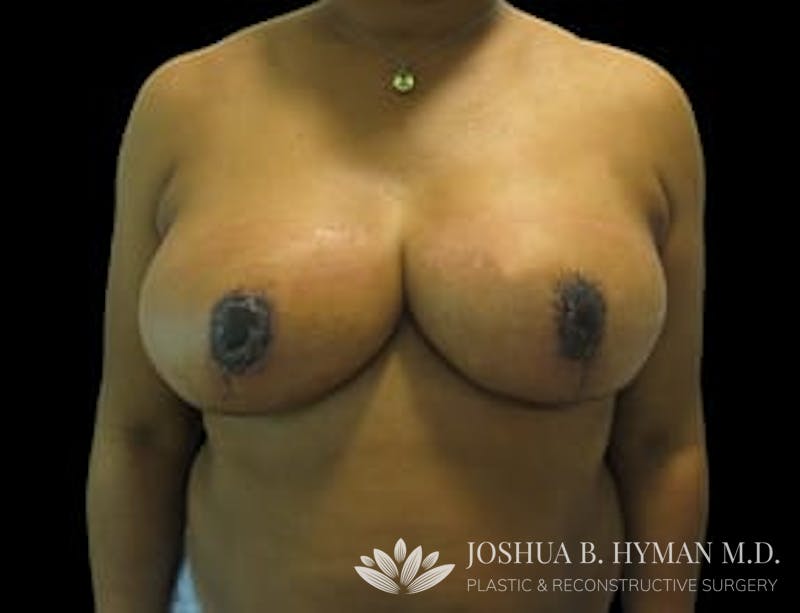 Breast Reduction Before & After Gallery - Patient 77369242 - Image 2