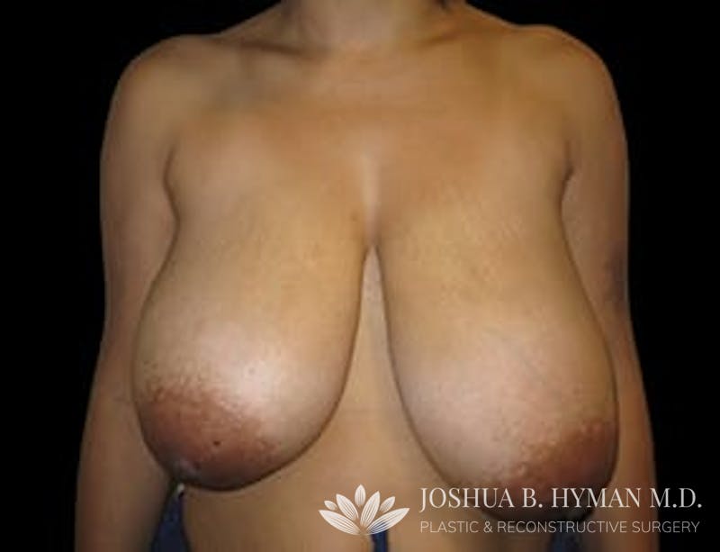 Breast Reduction Before & After Gallery - Patient 77369262 - Image 1