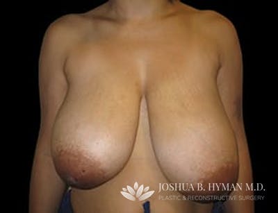 Breast Reduction Before & After Gallery - Patient 77369262 - Image 1