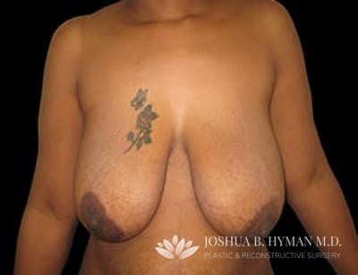 Breast Reduction Before & After Gallery - Patient 77369265 - Image 1