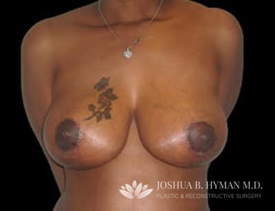 Breast Reduction Before & After Gallery - Patient 77369265 - Image 2