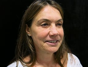 Facelift Before & After Gallery - Patient 77369268 - Image 3