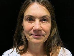 Facelift Before & After Gallery - Patient 77369268 - Image 1