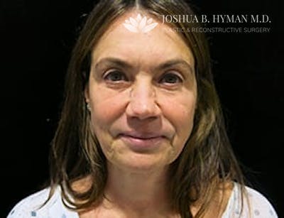 Facelift Before & After Gallery - Patient 77369268 - Image 1