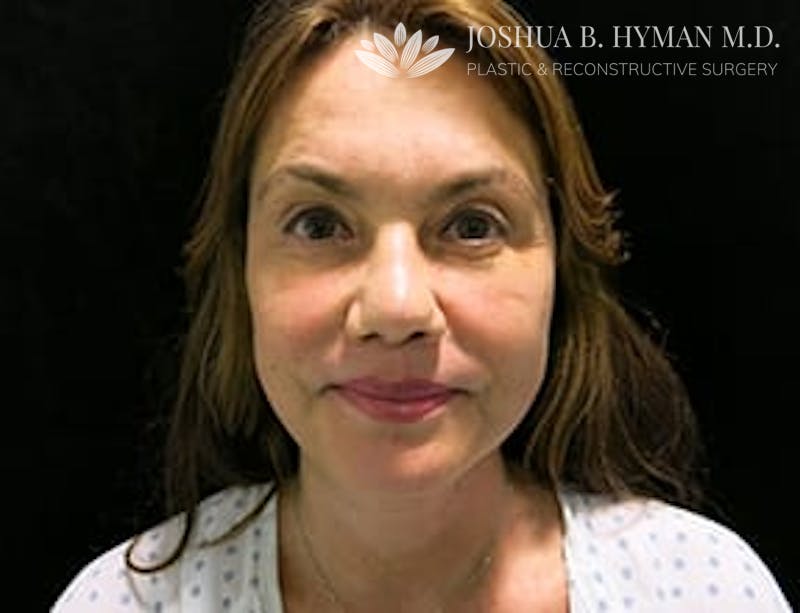 Facelift Before & After Gallery - Patient 77369268 - Image 2