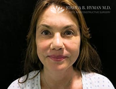 Facelift Before & After Gallery - Patient 77369268 - Image 2