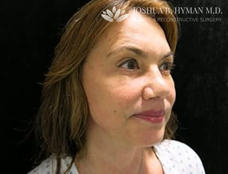 Facelift Before & After Gallery - Patient 77369268 - Image 4
