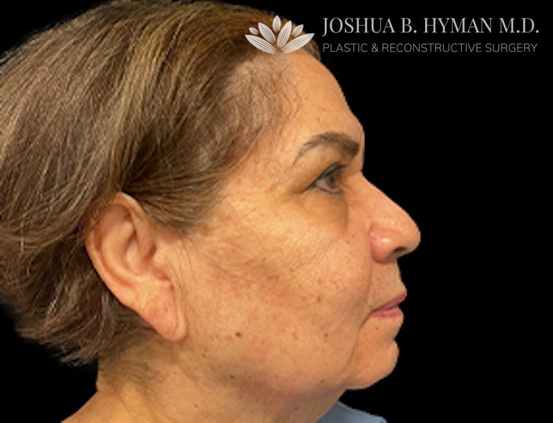 Facelift Before & After Gallery - Patient 77369274 - Image 1