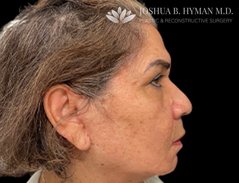 Facelift Before & After Gallery - Patient 77369274 - Image 2