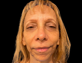 Facelift Before & After Gallery - Patient 77369273 - Image 1