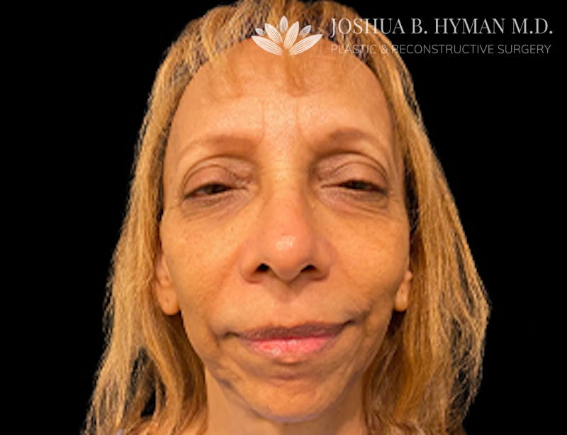 Facelift Before & After Gallery - Patient 77369273 - Image 1