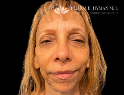 Facelift Before & After Gallery - Patient 77369273 - Image 1
